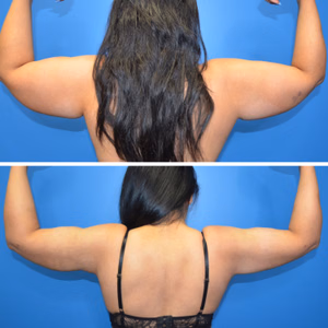 Liposuction before and after photo, front view