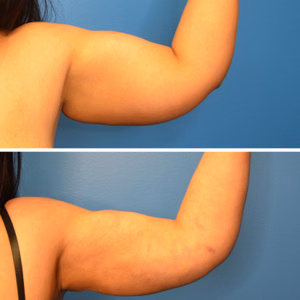 Liposuction before and after photo, side view