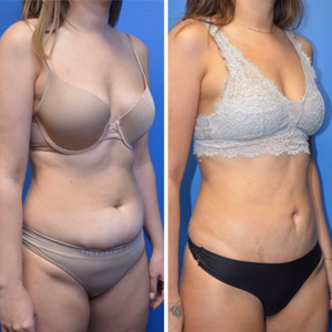 Liposuction before and after photo, front view