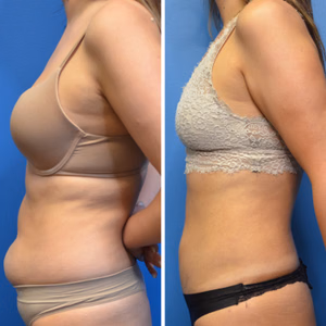 Liposuction before and after photo, side view