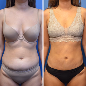 Liposuction before and after photo, front view