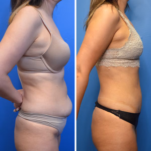 Liposuction before and after photo, side view