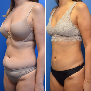 Liposuction before and after photo, side view