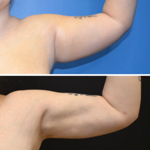 Liposuction before and after photo, side view