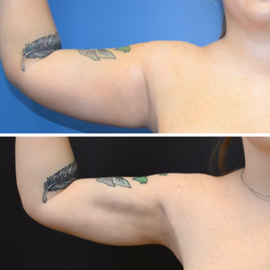 Liposuction before and after photo, front view