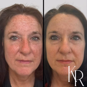 MOXI laser treatment before and after photo, close-up view