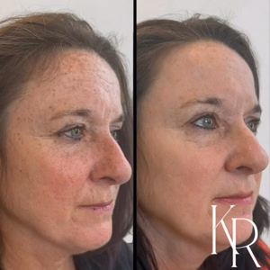 MOXI laser treatment before and after photo, close-up view