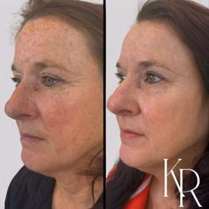 MOXI laser treatment before and after photo, close-up view