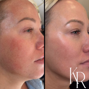 MOXI laser treatment before and after photo, close-up view