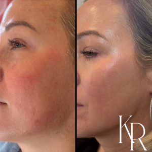 MOXI laser treatment before and after photo, side view