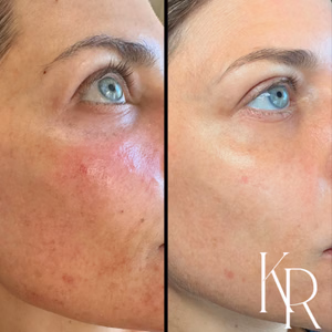 MOXI laser treatment before and after photo, close-up view