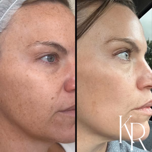 MOXI laser treatment before and after photo, close-up view