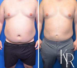 Liposuction body contouring before and after photo, front view