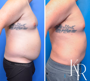 Liposuction body contouring before and after photo, side view
