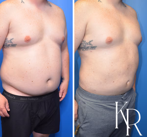 Liposuction body contouring before and after photo, front view