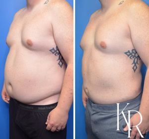 Liposuction body contouring before and after photo, oblique view