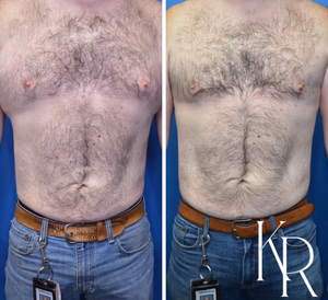 Liposuction body contouring before and after photo, front view