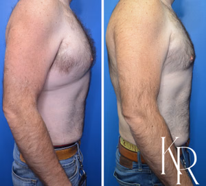 Liposuction body contouring before and after photo, side view
