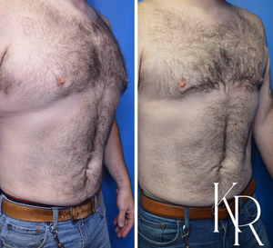 Liposuction body contouring before and after photo, oblique view