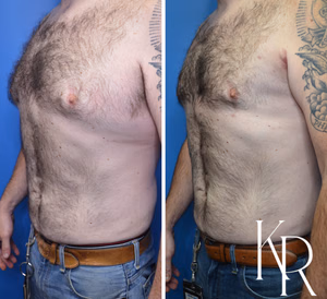 Liposuction body contouring before and after photo, oblique view