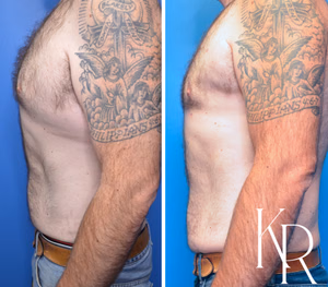 Liposuction body contouring before and after photo, side view