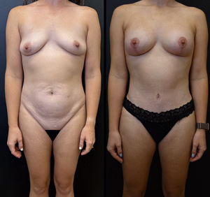 Mommy makeover before and after photo, front view