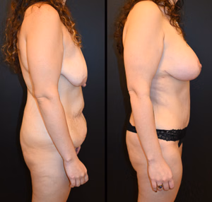 Mommy makeover before and after photo, side view