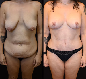 Mommy makeover before and after photo, front view