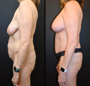 Mommy makeover before and after photo, front view