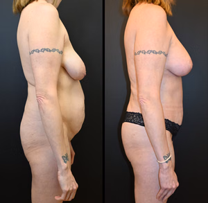 Mommy makeover before and after photo, front view