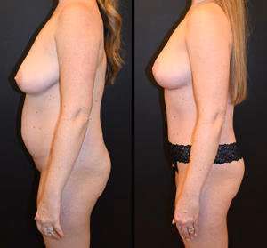 Mommy makeover before and after photo, front view