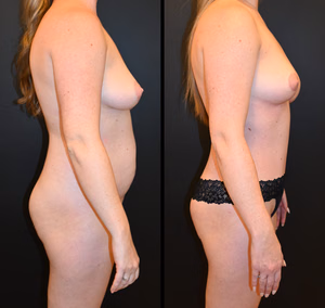 Mommy makeover before and after photo, front view