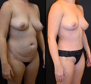 Mommy makeover before and after photo, side view