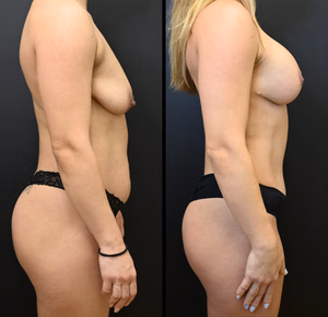 Mommy makeover before and after photo, side view