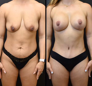 Mommy makeover before and after photo, front view