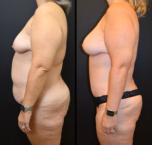 Mommy makeover before and after photo, side view