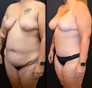 Mommy makeover before and after photo, front view