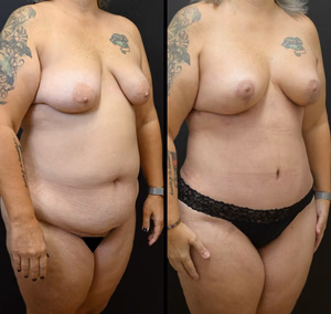 Mommy makeover before and after photo, front view