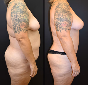 Mommy makeover before and after photo, side view