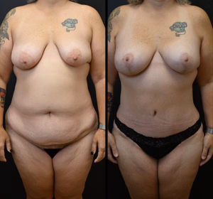 Mommy makeover before and after photo, front view