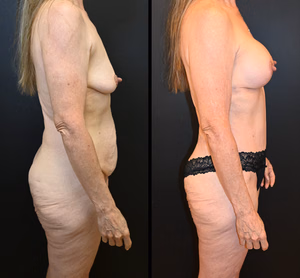 Mommy makeover before and after photo, side view