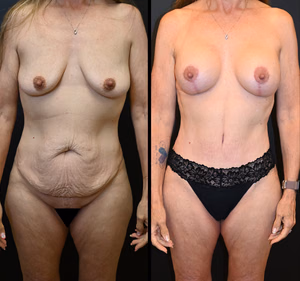 Mommy makeover before and after photo, front view