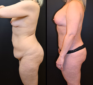 Mommy makeover before and after photo, front view
