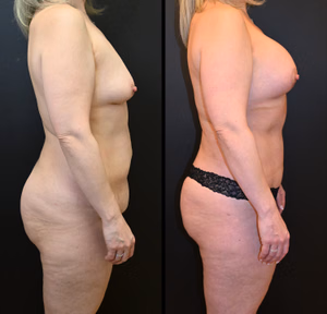 Mommy makeover before and after photo, side view