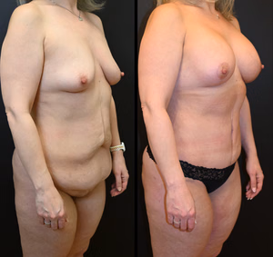 Mommy makeover before and after photo, front view