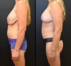 Mommy makeover before and after photo, side view