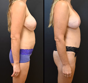 Mommy makeover before and after photo, side view