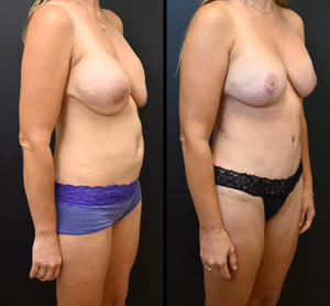 Mommy makeover before and after photo, front view