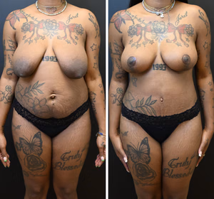 Mommy makeover before and after photo, front view