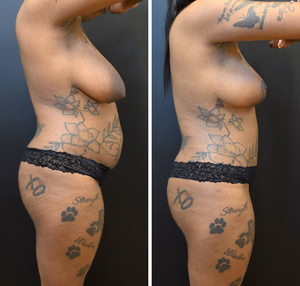 Mommy makeover before and after photo, side view